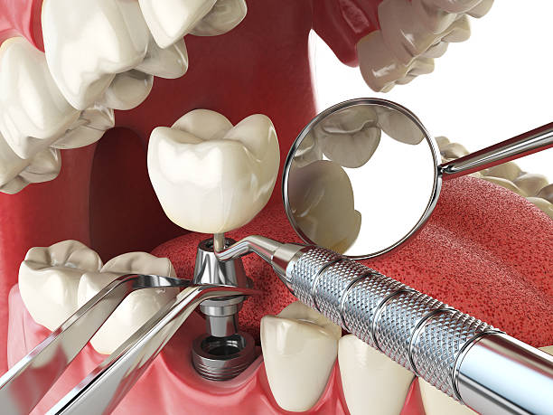 Best Dental Abscess Treatment in Houghton Lake, MI